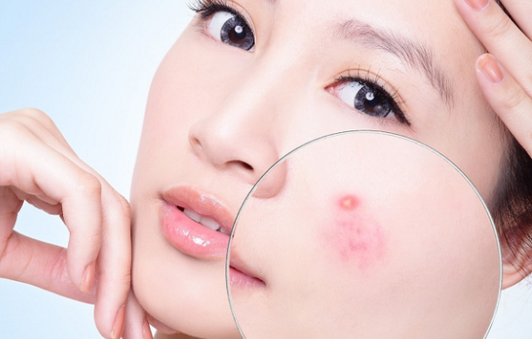 Tìm hiểu và phân biệt các loại mụn